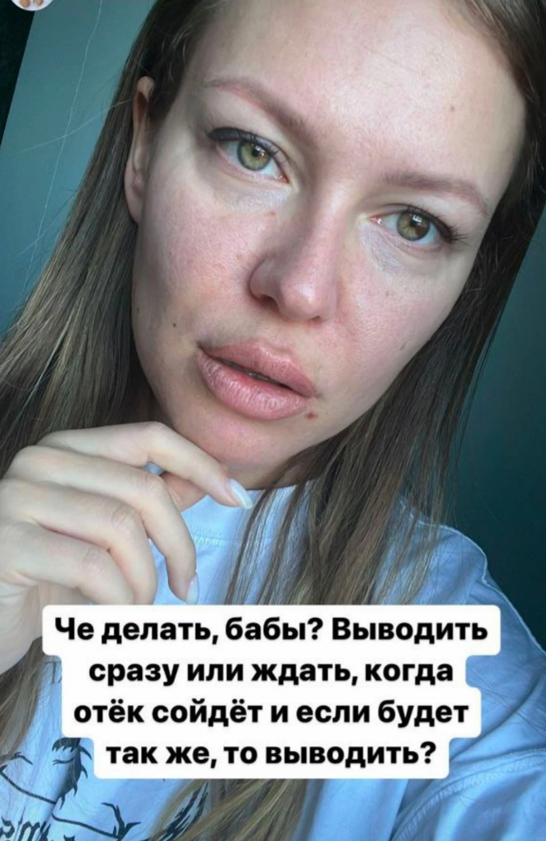 Рита Дакота показывает результат коррекции губ
Фото: Инстаграм (запрещен в РФ) Риты Дакоты