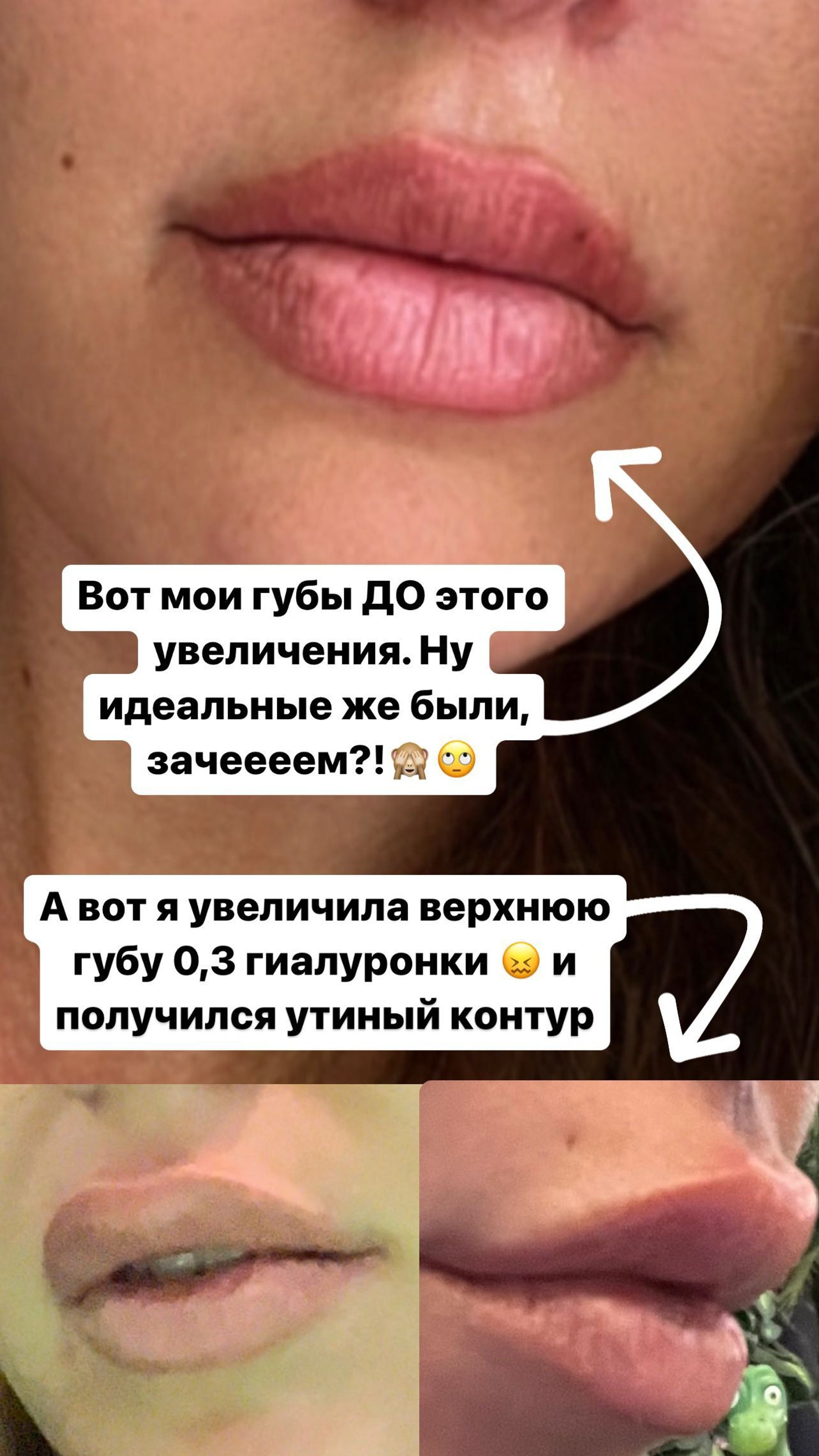 Губы Риты Дакоты до и после увеличения
Фото: Инстаграм (запрещен в РФ) Риты Дакоты
