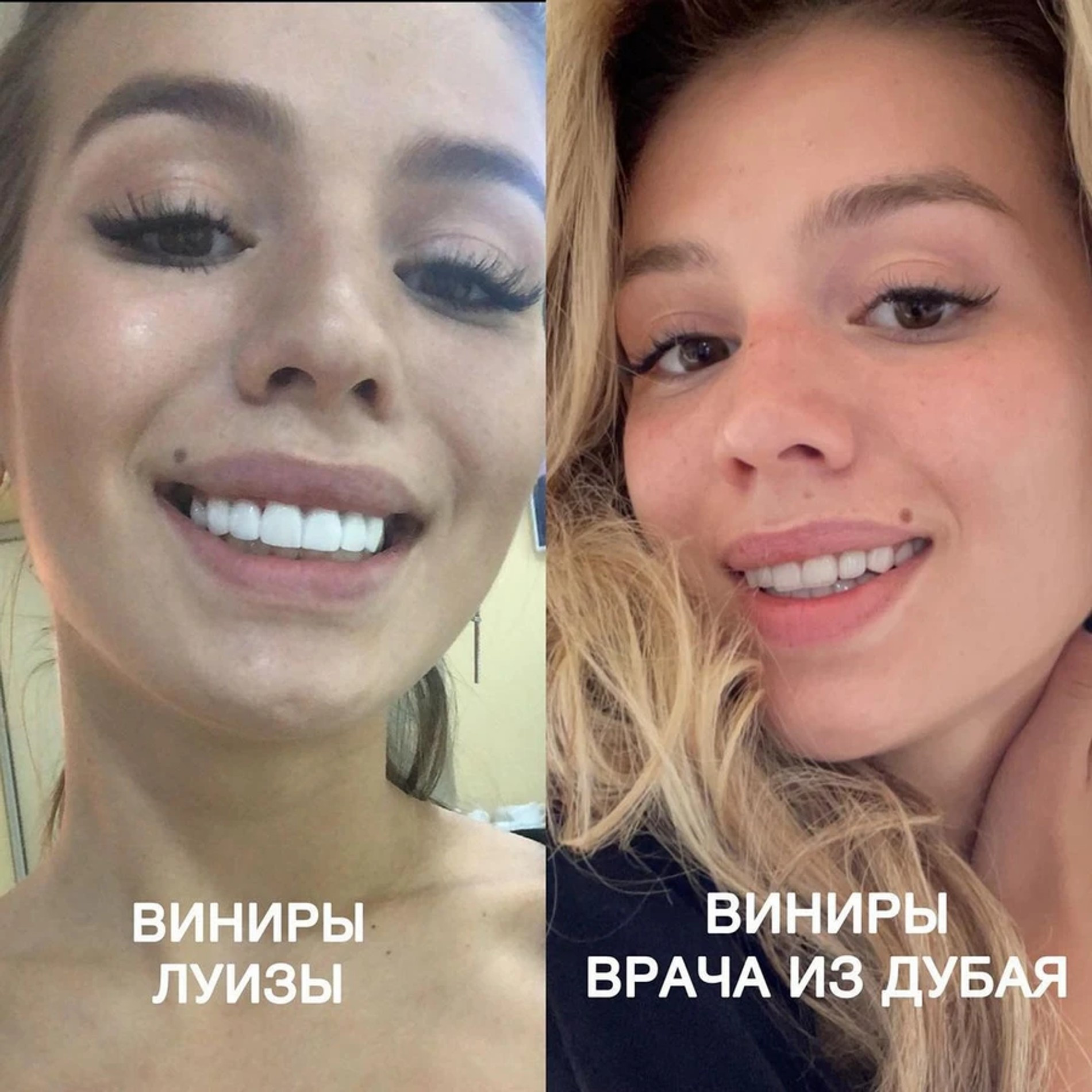 Люся Чеботина показала работы разных стоматологов
Фото: Инстаграм (запрещен в РФ) / @lusia_chebotina