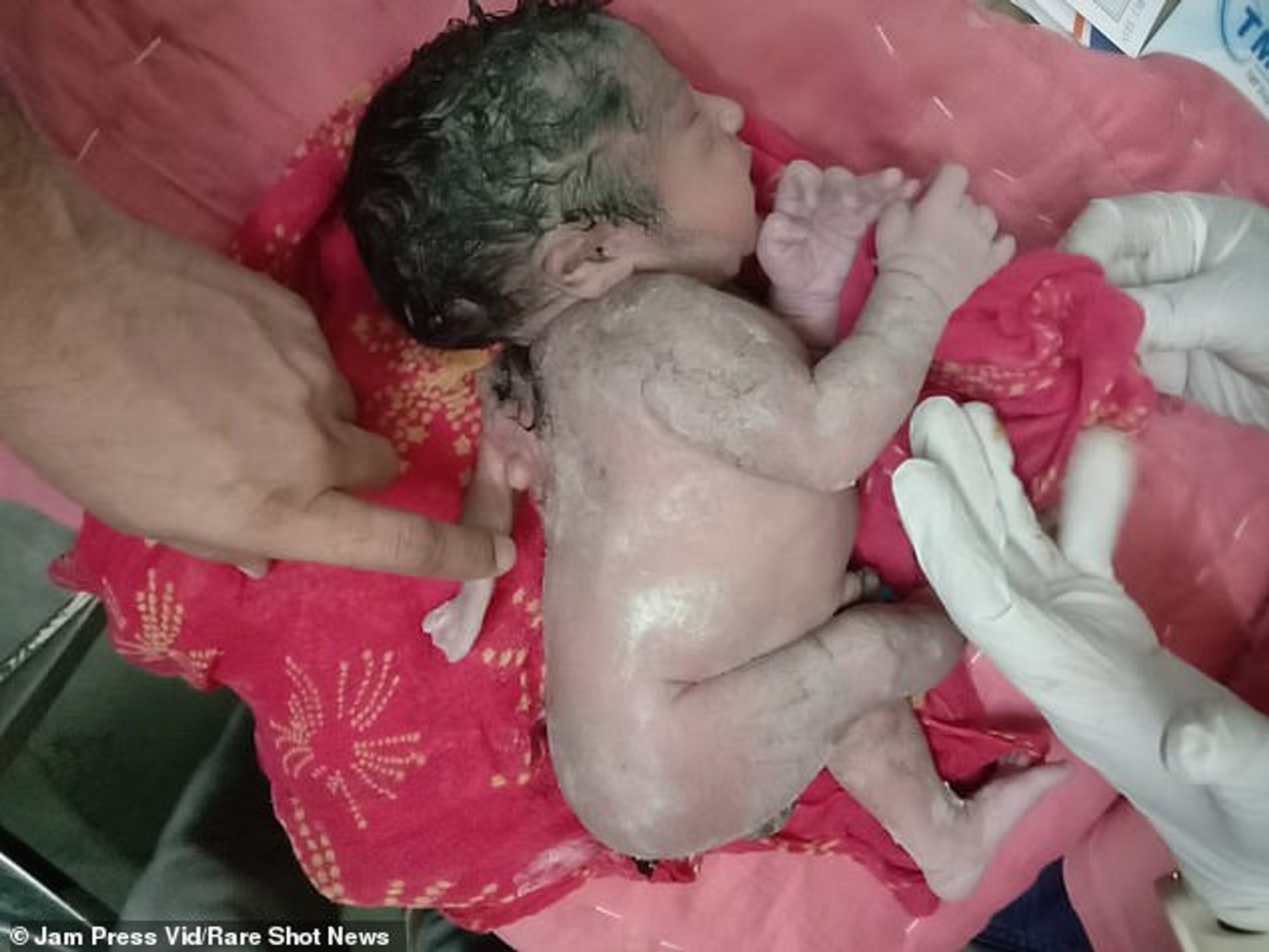 Новорожденный малыш с третьей рукой на спине
Фото: Rare Shot News