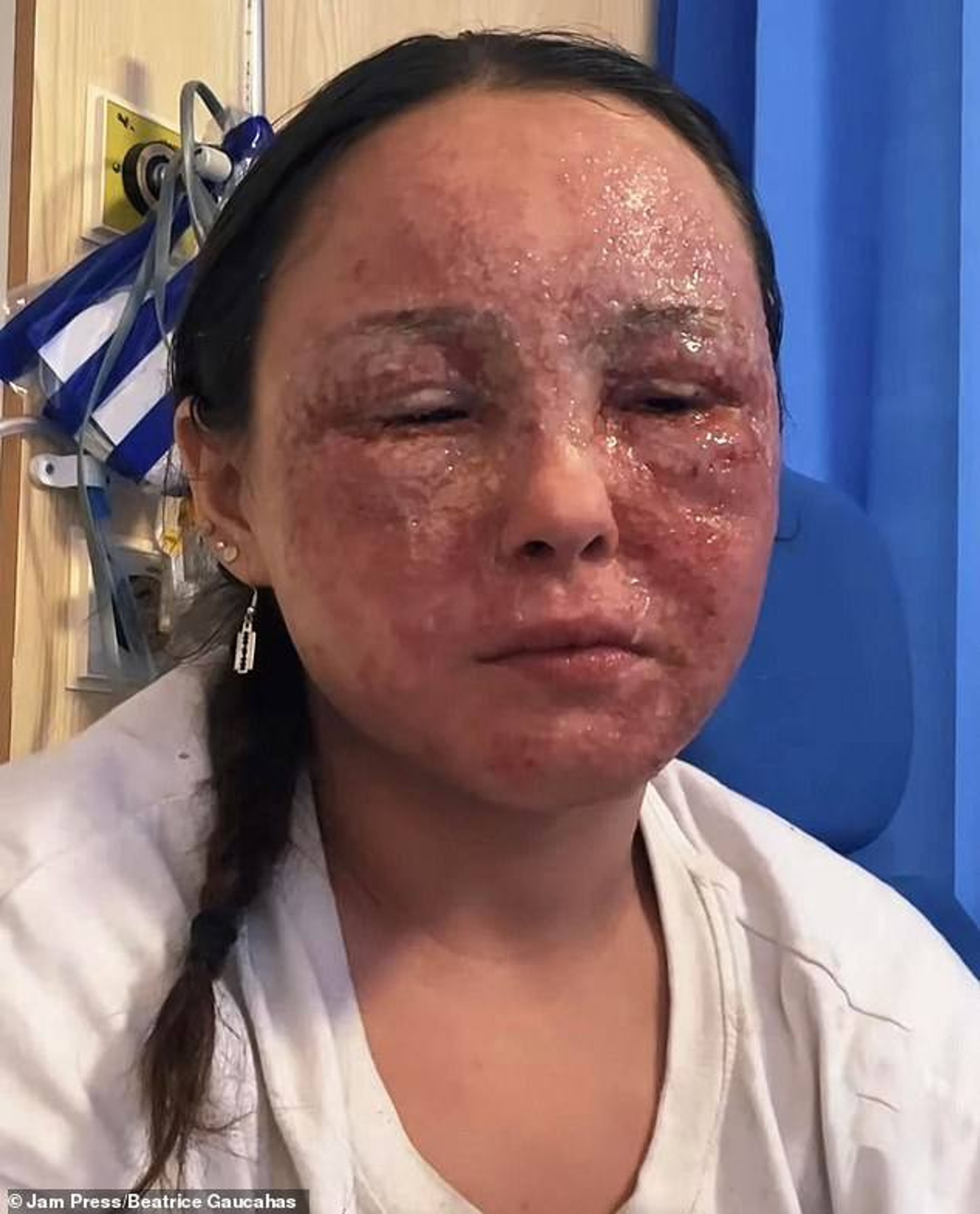 Беатрис Гуакаас во время обострения экземы. Фото: Daily Mail
