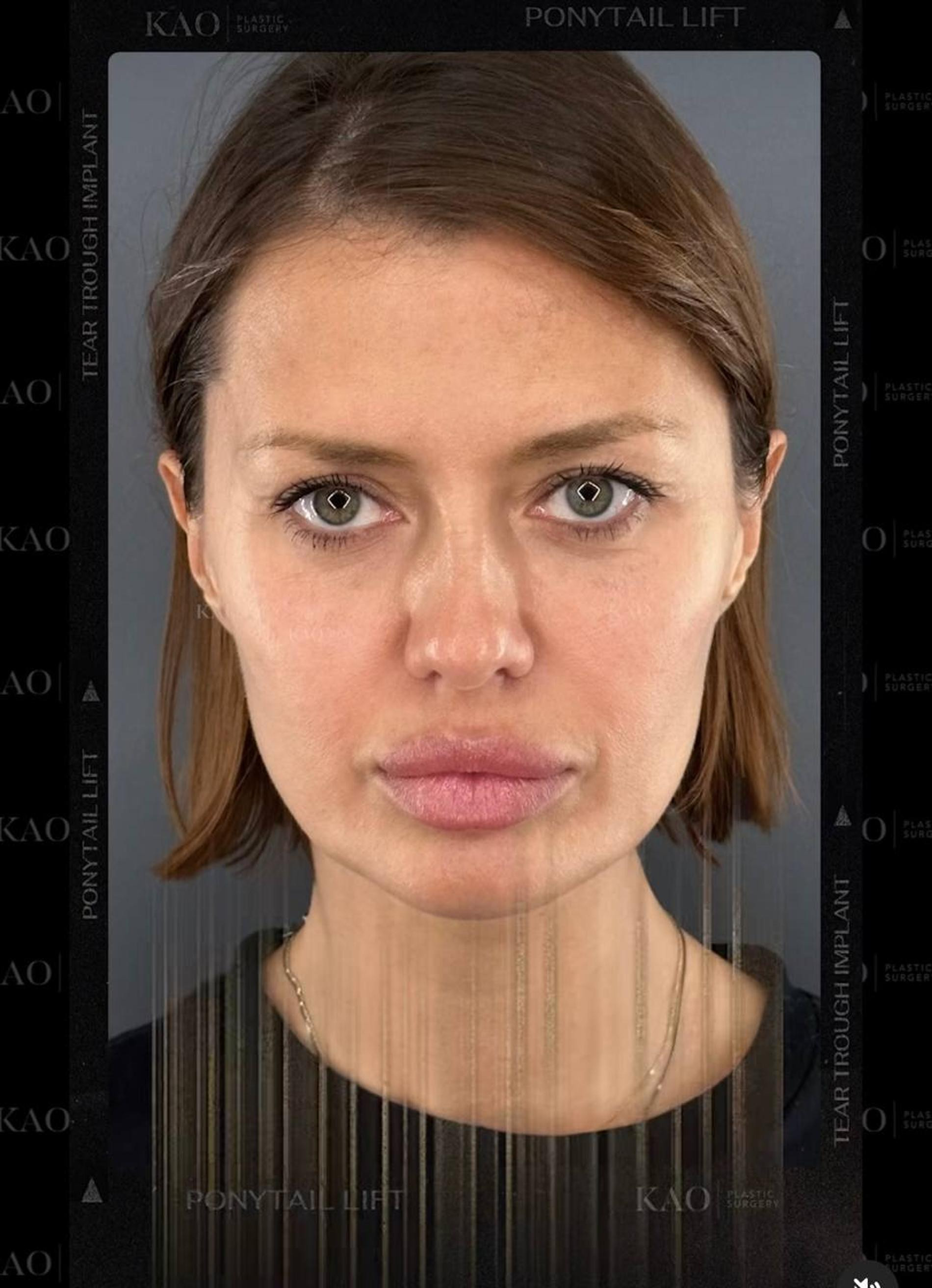 Лицо Виктории Бони до операции. Фото: Инстаграм* @kaoplasticsurgery