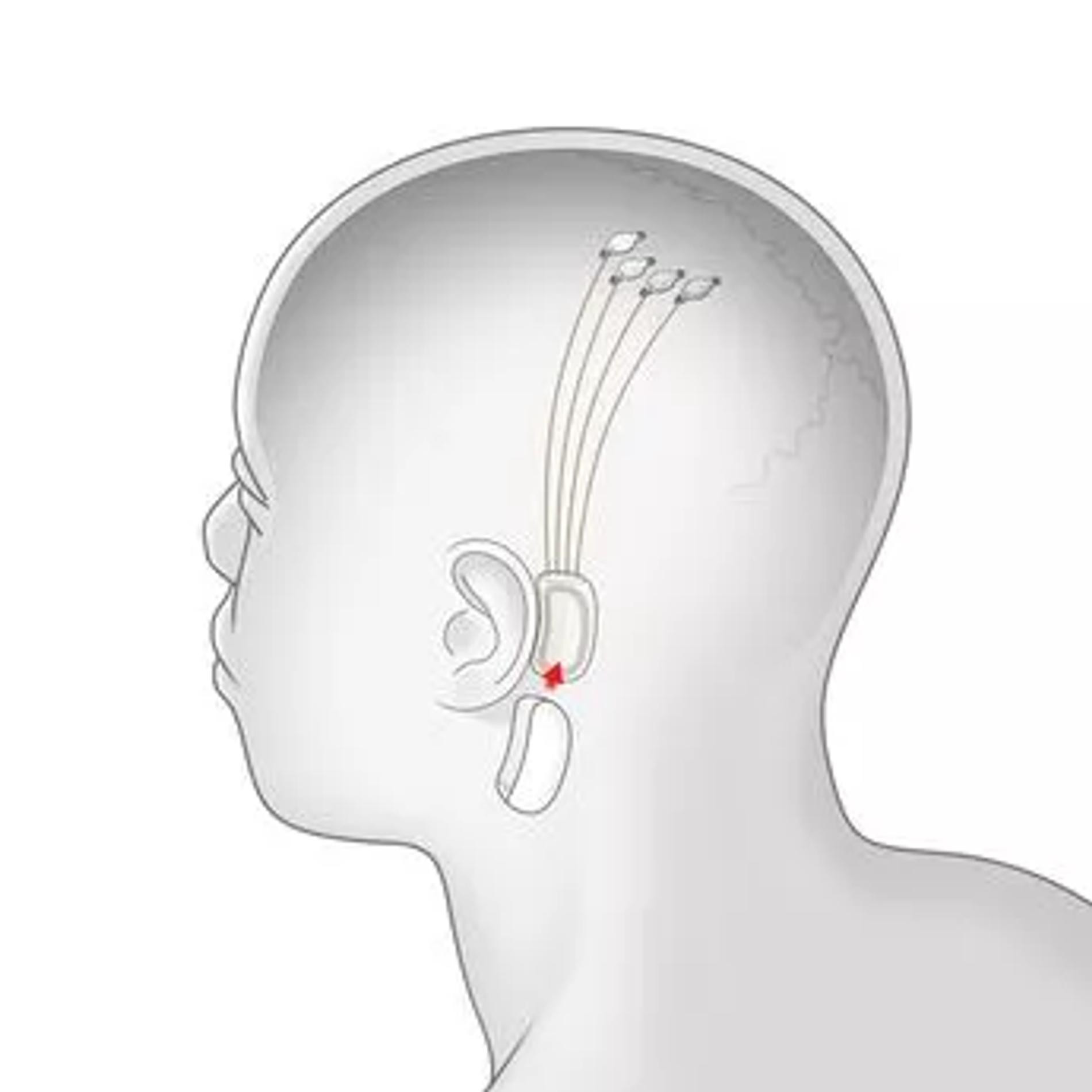 Иллюстрация того, как работает устройство. Фото: Neuralink