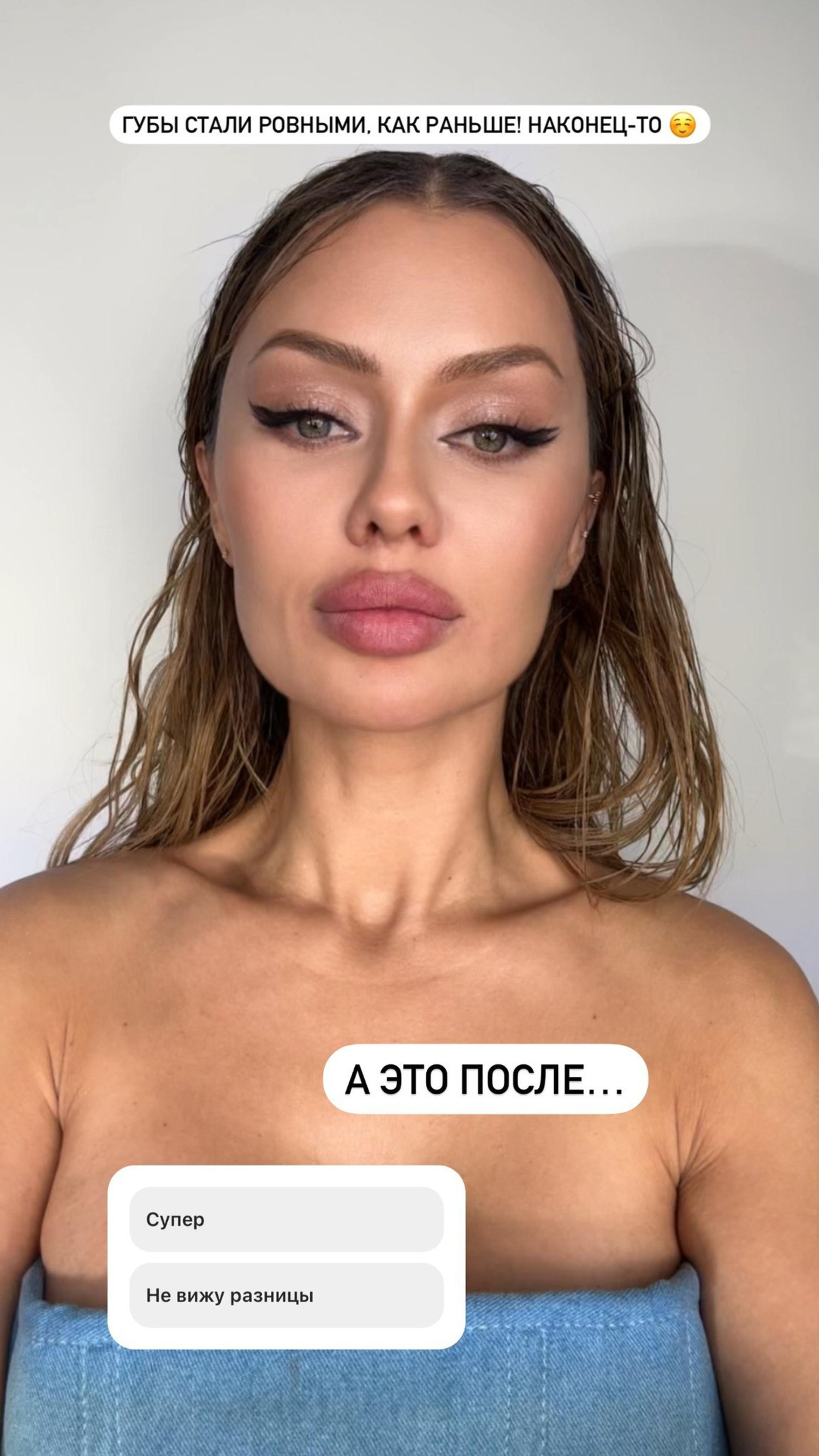 Виктория Боня после увеличения губ. Фото: Инстаграм* @victoriabonya