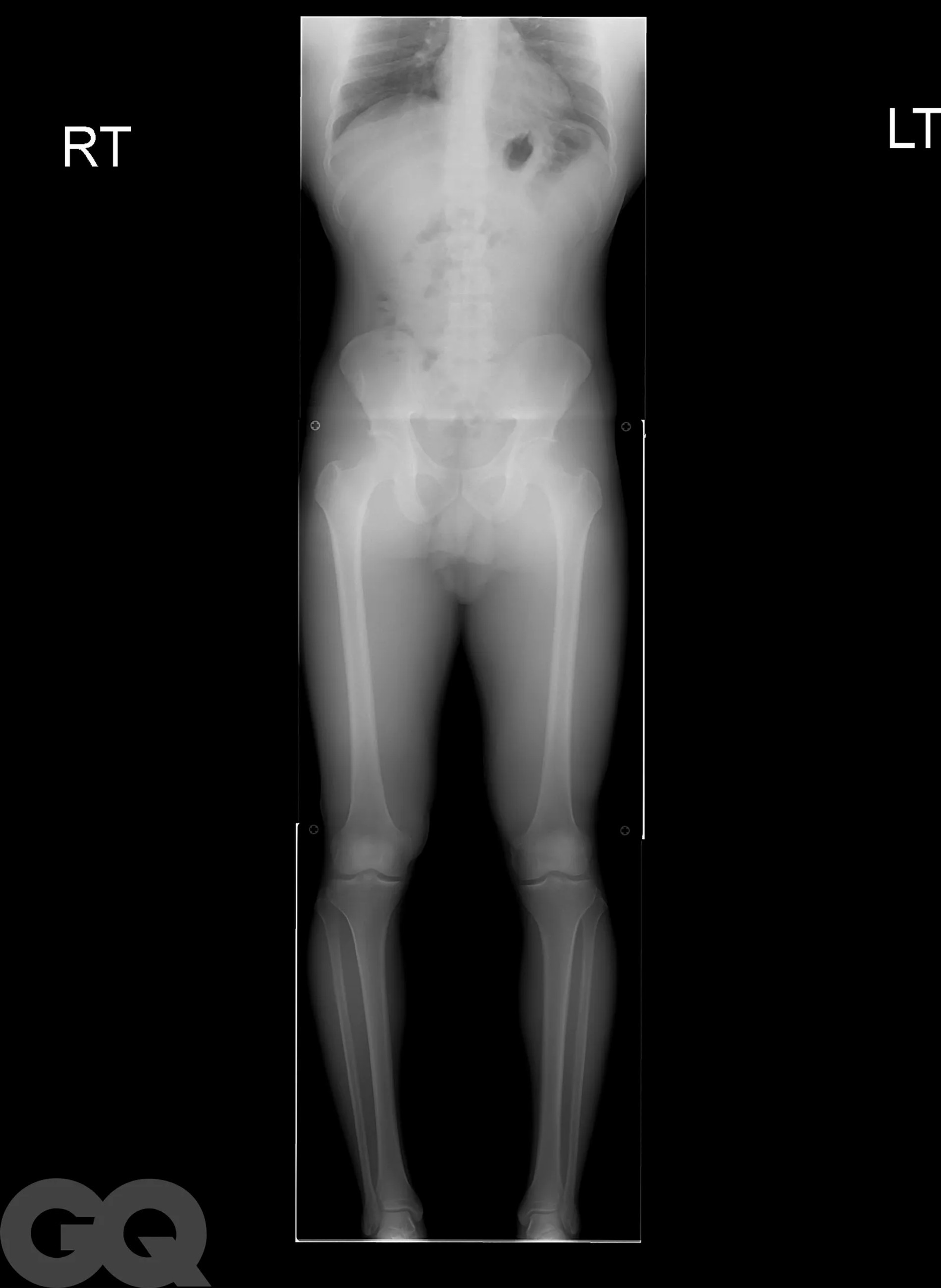 Рентгенограммы до операции пациента, у которого были удлинены бедра и голени, что увеличило их рост на шесть дюймов.
Фото: GQ.сom