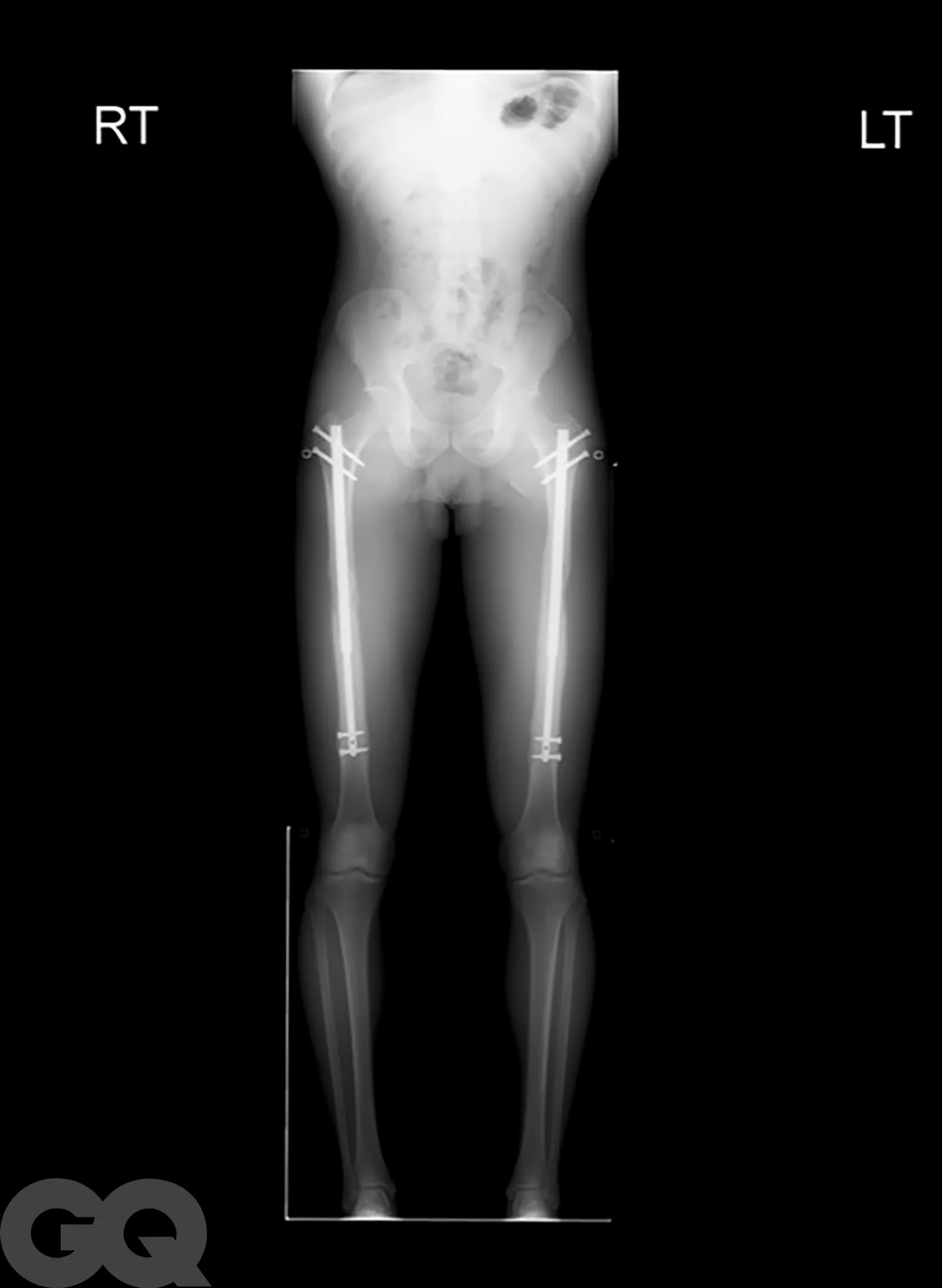 Рентгенограммы пациента в процессе реабилитации, у которого были удлинены бедра и голени, что увеличило их рост на шесть дюймов.
Фото: GQ.сom