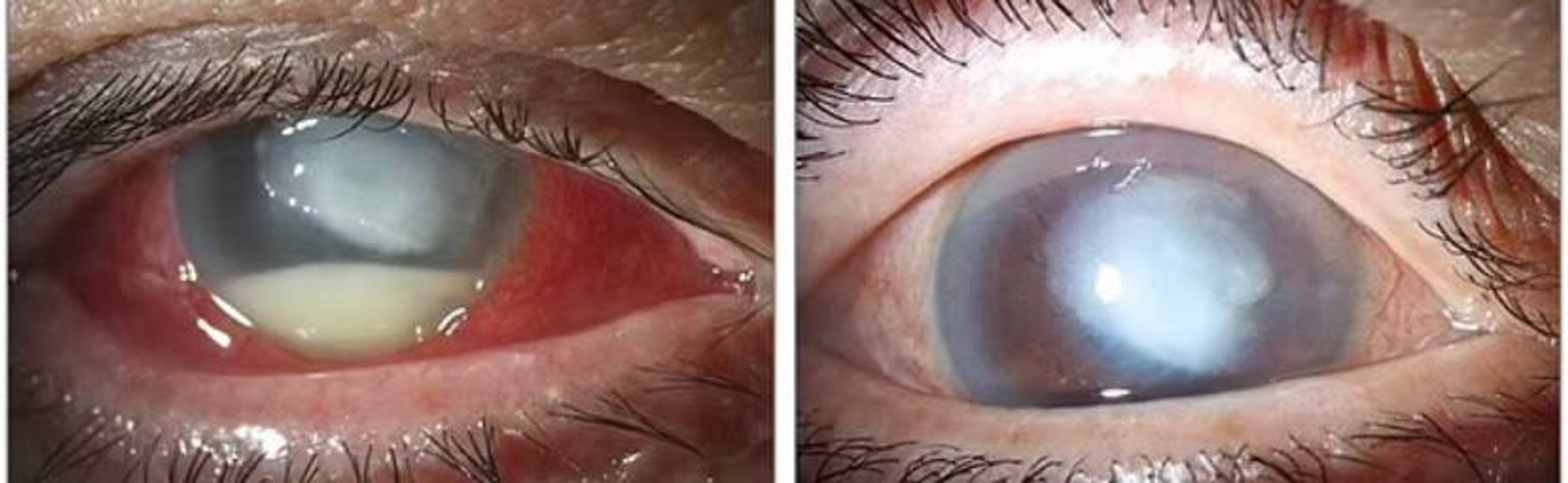 Фото зараженного глаза с применением щелевой лампы до и спустя месяц после лечения
Фото: Daily Mail 