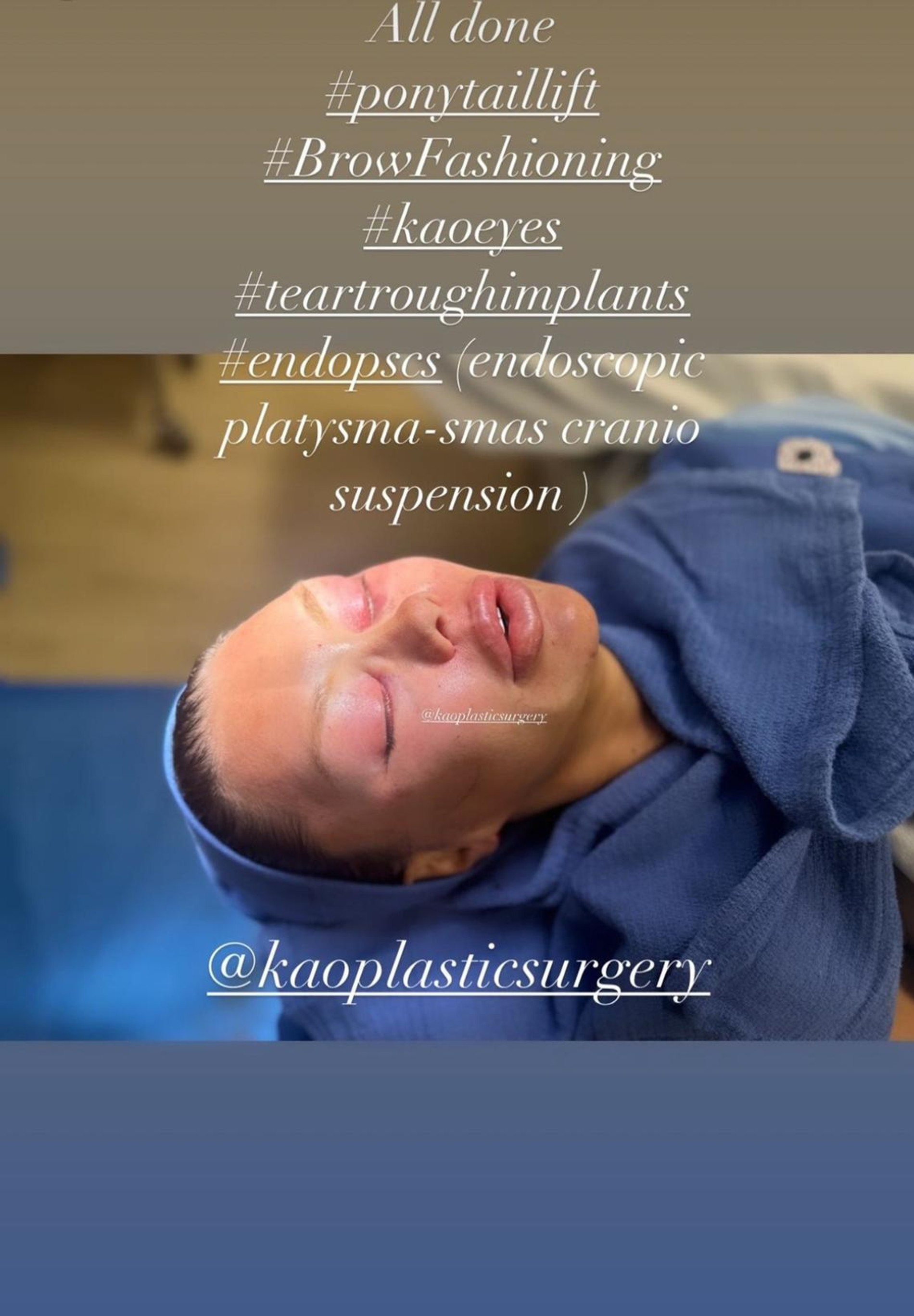Виктория Боня сразу после операции. Фото: Инстаграм* @kaoplasticsurgery