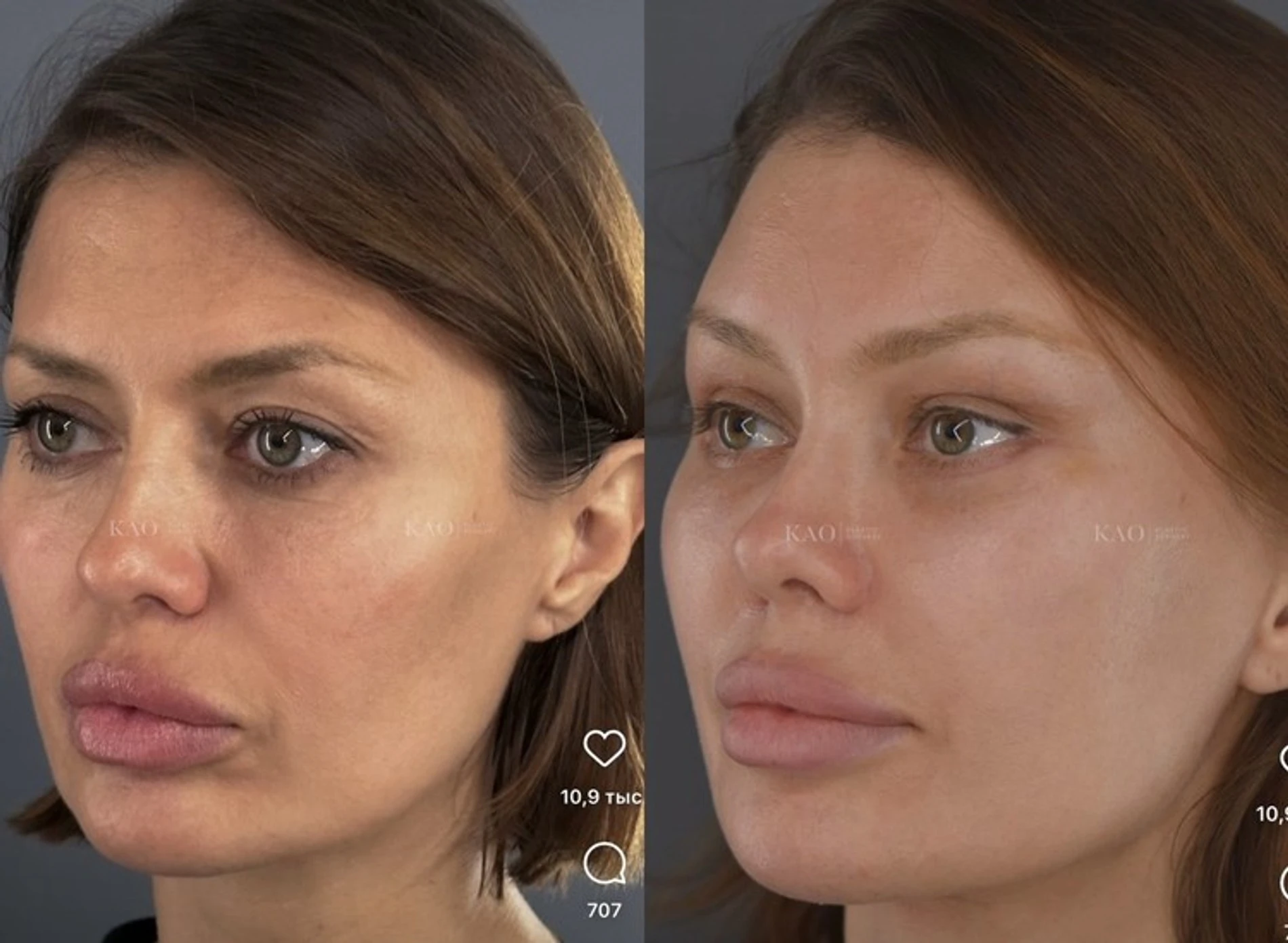 Виктория Боня до и после пластический операции. Фото: Инстаграм* @kaoplasticsurgery
