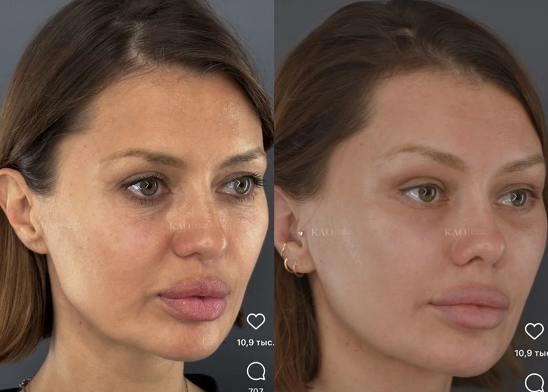 Виктория Боня до и после пластический операции. Фото: Инстаграм* @kaoplasticsurgery