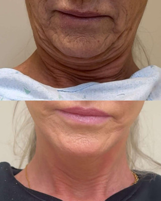 До операции и через 10 месяцев после. Фото: People