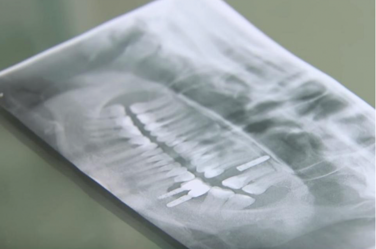 Снимок зубов Кати Лель. Фото: соцсети