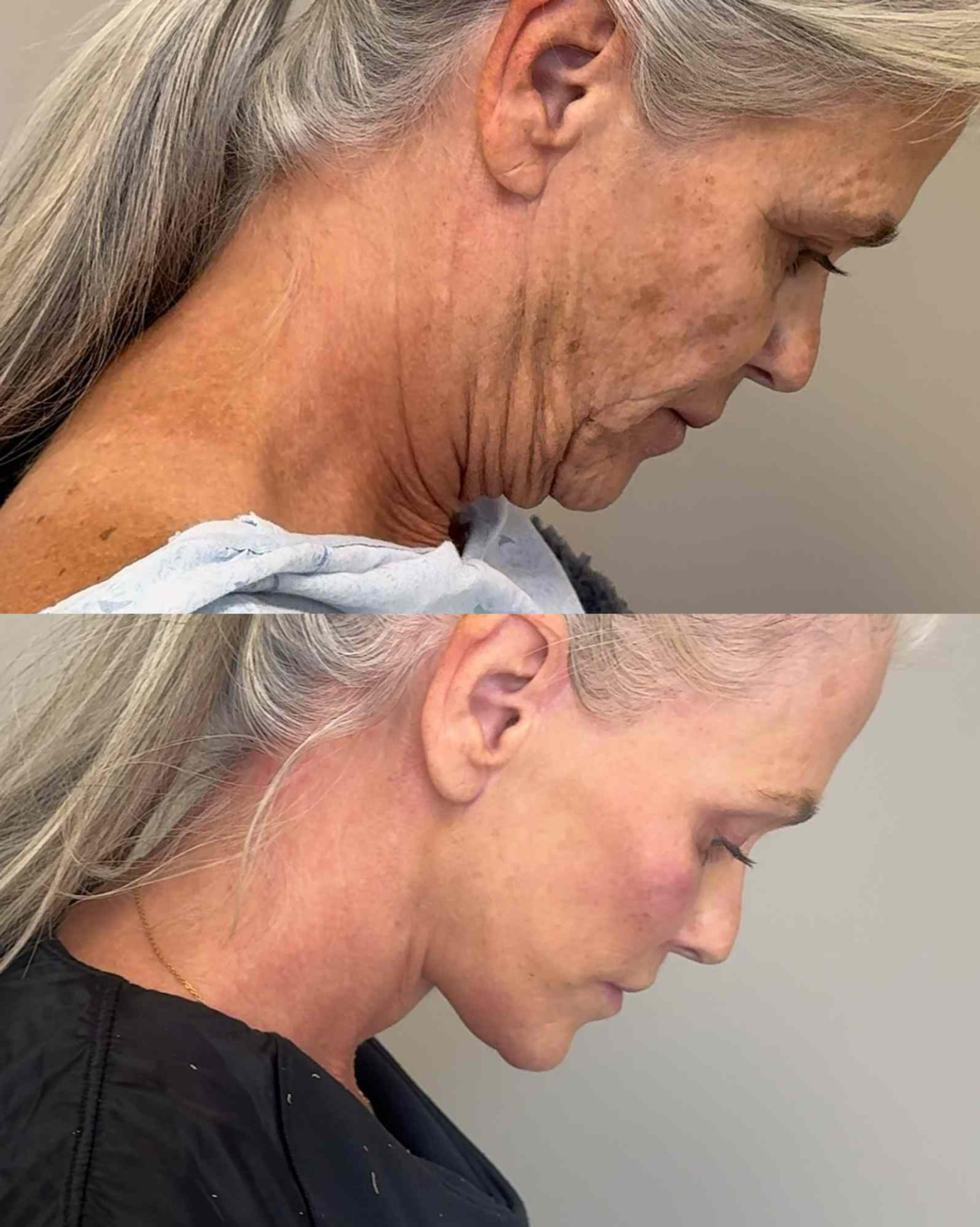 До операции и через 10 месяцев после. Фото: People