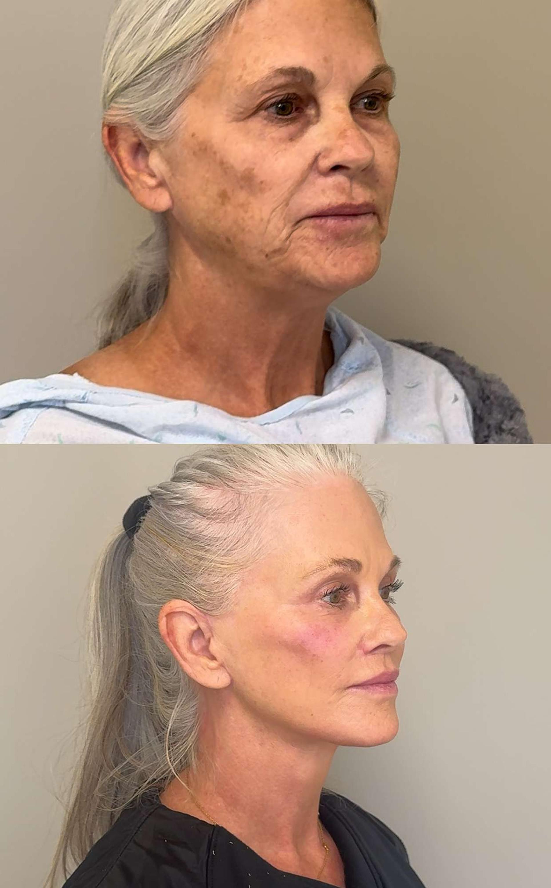 До операции и через 10 месяцев после. Фото: People